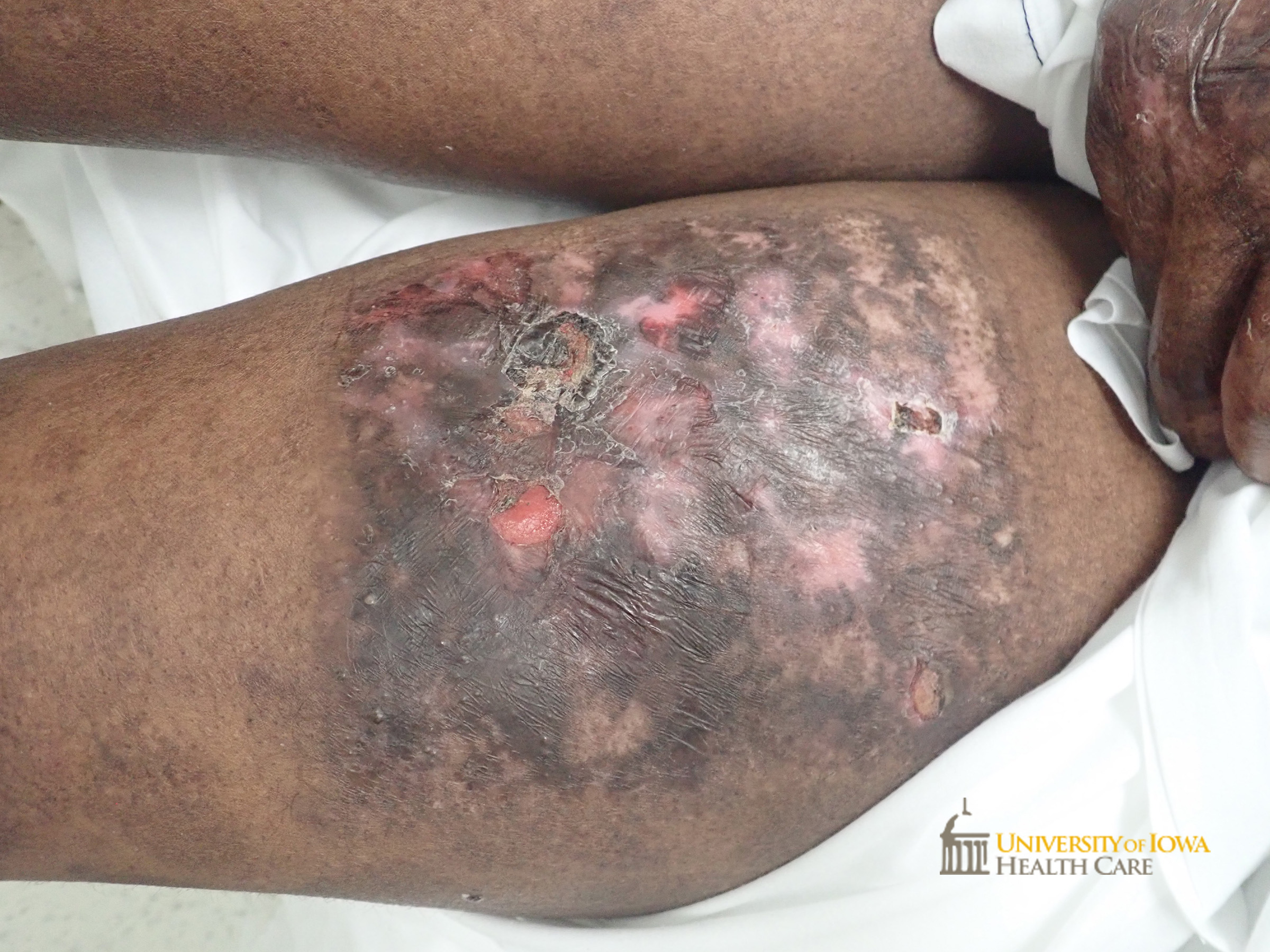 Hyperpigmented plaque with focal areas of erosion and pink scarring on the upper thigh. (click images for higher resolution).